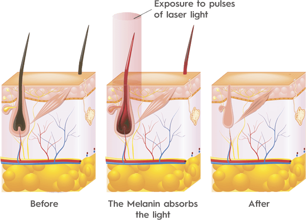 How IPL Hair Removal Works Rainham Medway Kent How IPL Hair Removal Works Rainham Medway Kent