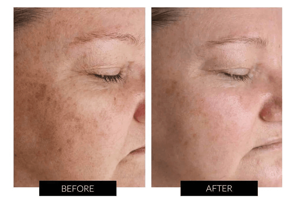 Understanding Melasma: And Exploring the Differences from General Pigmentation
