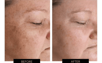 Understanding Melasma: And Exploring the Differences from General Pigmentation