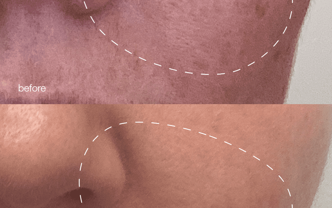 If you have melasma this is for you!