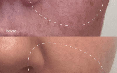 If you have melasma this is for you!