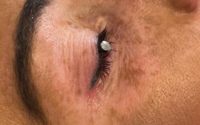 Laser Eyeliner removal